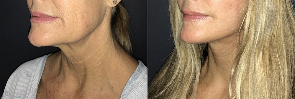 Real Patient Results in Newport Beach, CA. Preformed by Semira Bayait, MD, FACS.