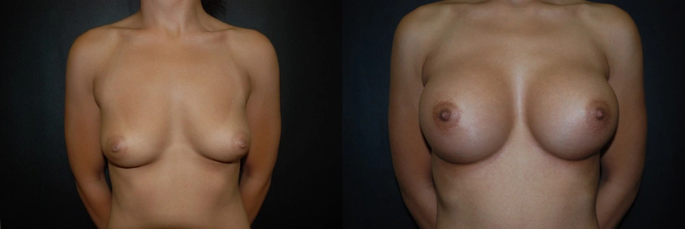 Real Patient Results in Newport Beach, CA. Preformed by Semira Bayait, MD, FACS.