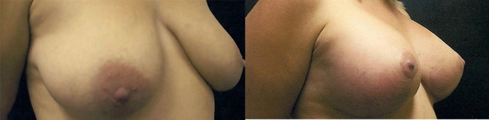 Real Patient Results in Newport Beach, CA. Preformed by Semira Bayait, MD, FACS.