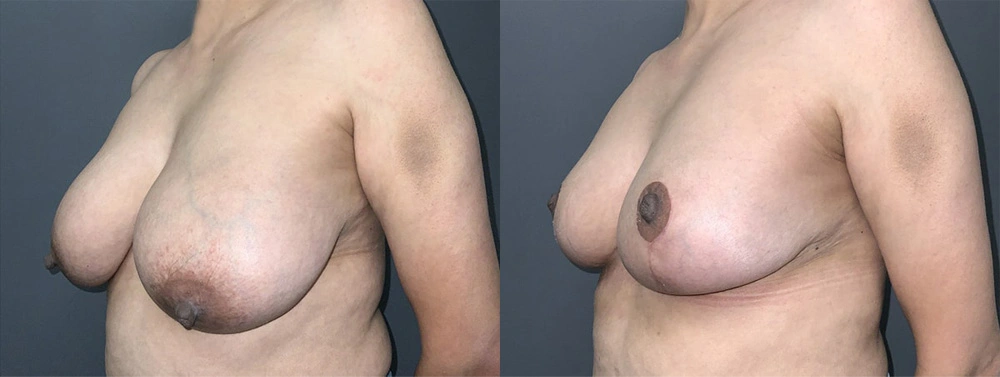 Real Patient Results in Newport Beach, CA. Preformed by Semira Bayait, MD, FACS.