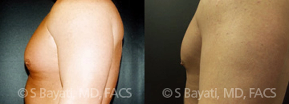Real Patient Results in Newport Beach, CA. Preformed by Semira Bayait, MD, FACS.