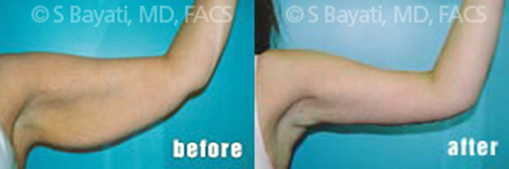 Real Patient Results in Newport Beach, CA. Preformed by Semira Bayait, MD, FACS.