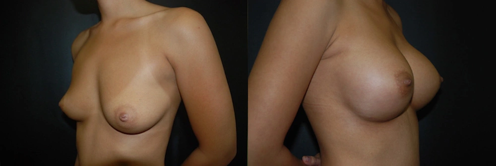 Real Patient Results in Newport Beach, CA. Preformed by Semira Bayait, MD, FACS.