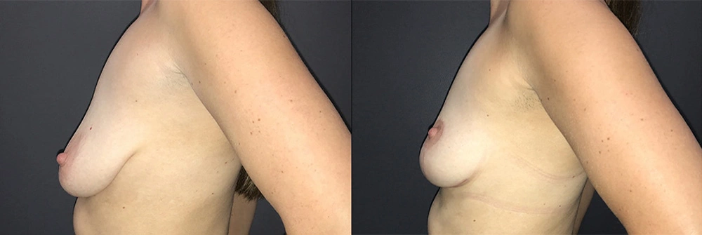 Real Patient Results in Newport Beach, CA. Preformed by Semira Bayait, MD, FACS.