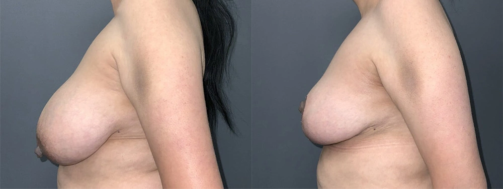 Real Patient Results in Newport Beach, CA. Preformed by Semira Bayait, MD, FACS.