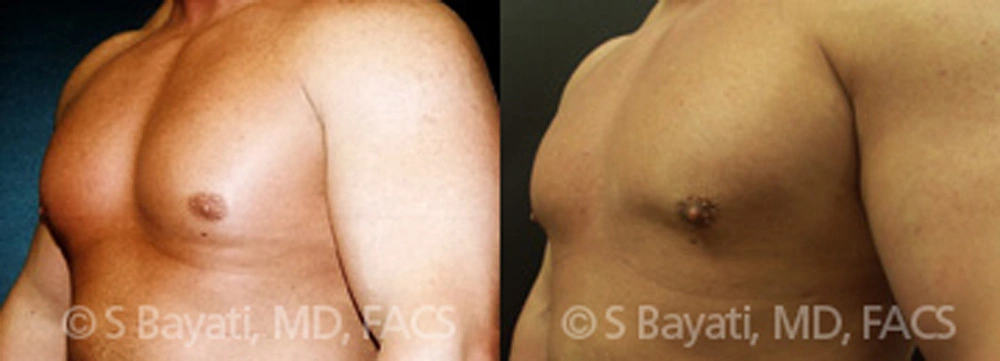 Real Patient Results in Newport Beach, CA. Preformed by Semira Bayait, MD, FACS.