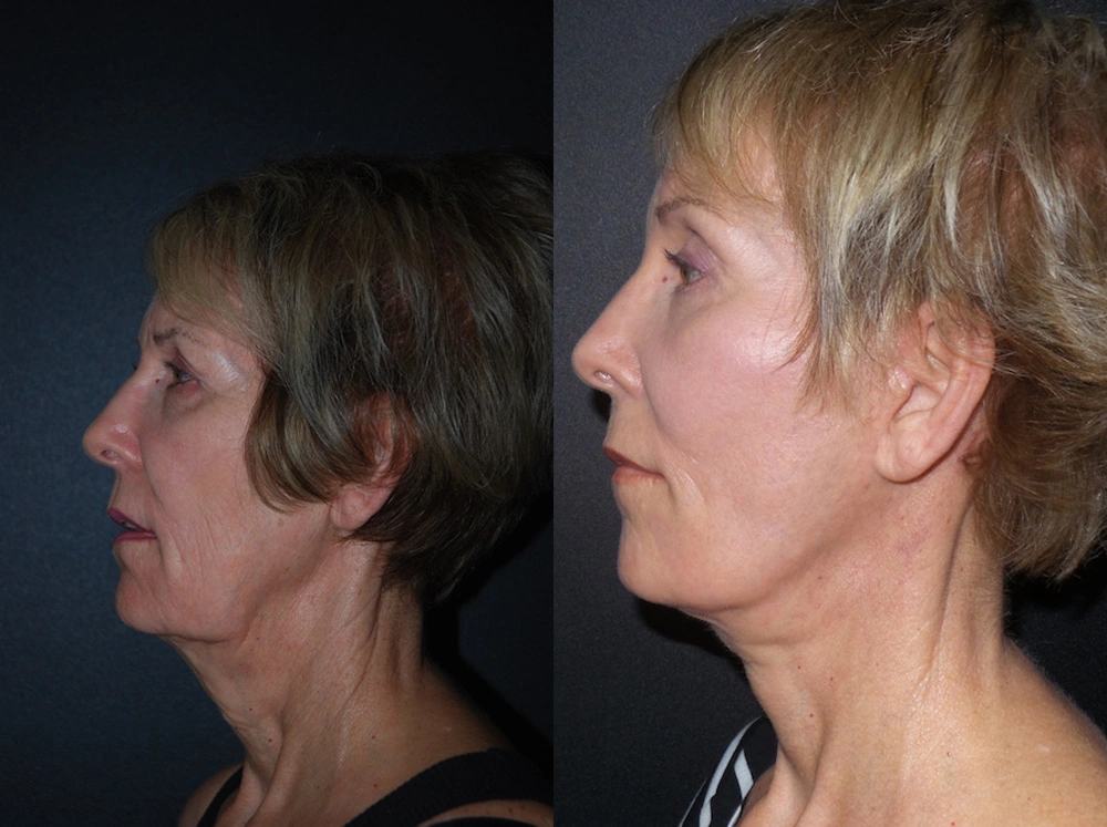 Real Patient Results in Newport Beach, CA. Preformed by Semira Bayait, MD, FACS.