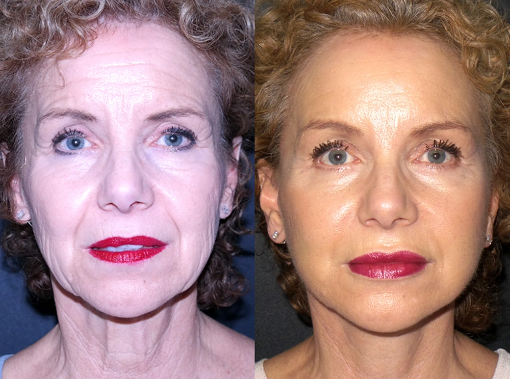 Real Patient Results in Newport Beach, CA. Preformed by Semira Bayait, MD, FACS.