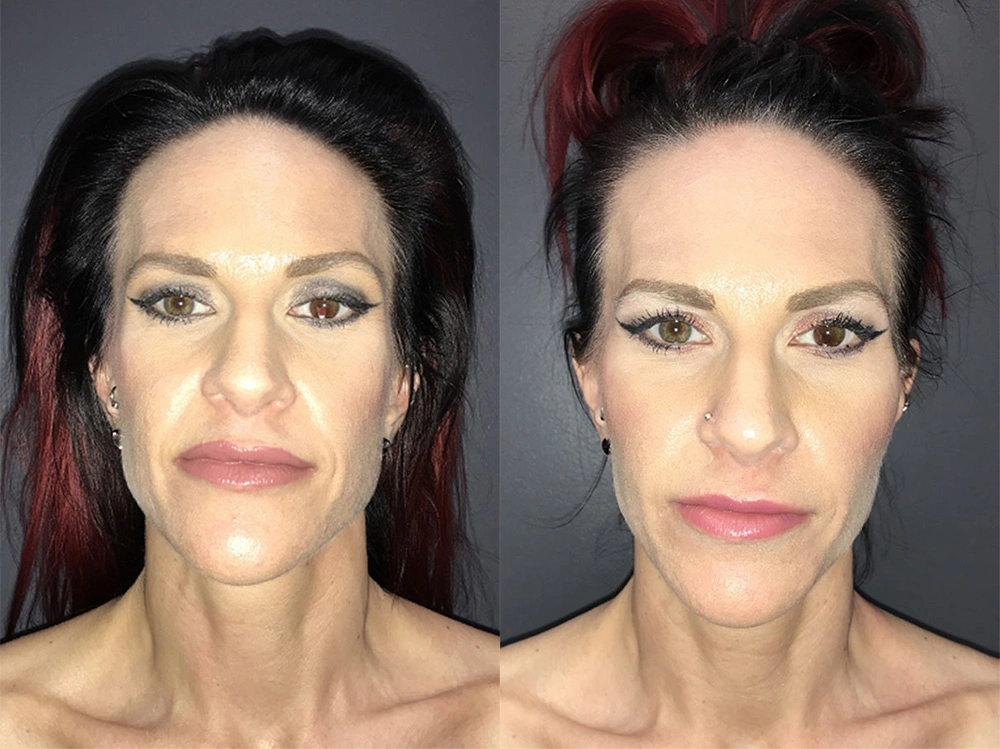 Real Patient Results in Newport Beach, CA. Preformed by Semira Bayait, MD, FACS.