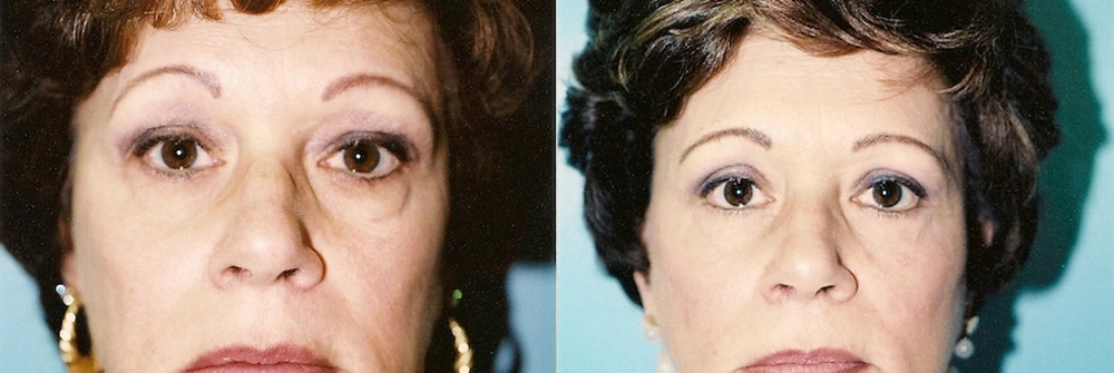 Real Patient Results in Newport Beach, CA. Preformed by Semira Bayait, MD, FACS.