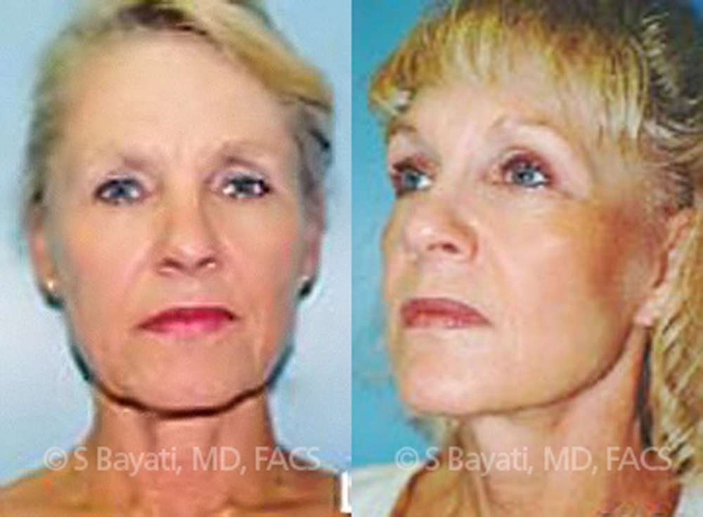Real Patient Results in Newport Beach, CA. Preformed by Semira Bayait, MD, FACS.