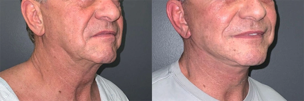 Real Patient Results in Newport Beach, CA. Preformed by Semira Bayait, MD, FACS.