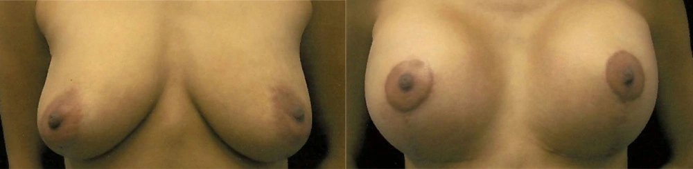 Real Patient Results in Newport Beach, CA. Preformed by Semira Bayait, MD, FACS.