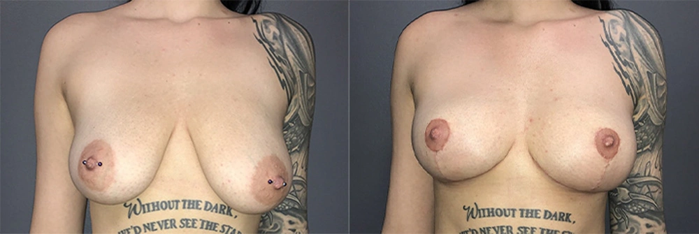 Real Patient Results in Newport Beach, CA. Preformed by Semira Bayait, MD, FACS.