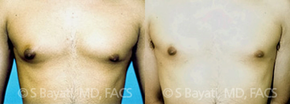 Real Patient Results in Newport Beach, CA. Preformed by Semira Bayait, MD, FACS.