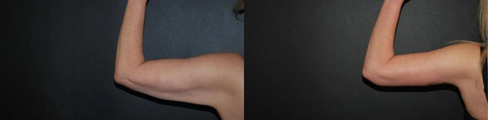 Real Patient Results in Newport Beach, CA. Preformed by Semira Bayait, MD, FACS.