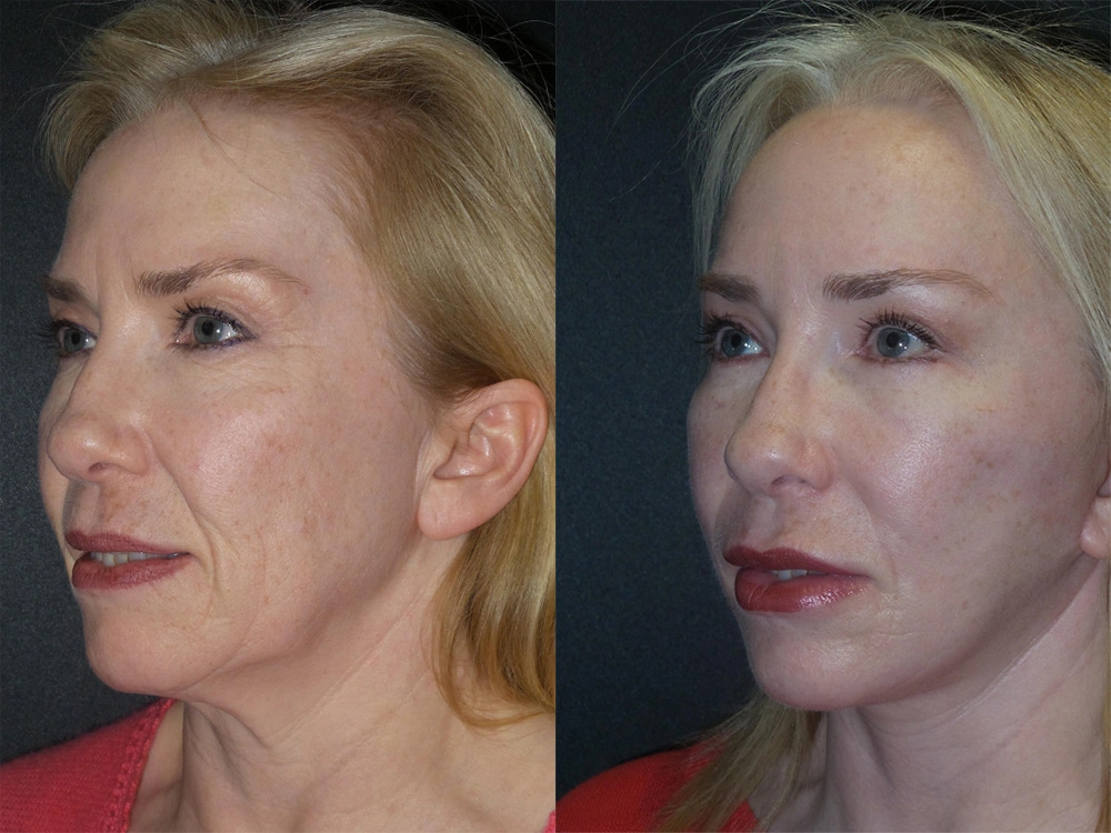 Real Patient Results in Newport Beach, CA. Preformed by Semira Bayait, MD, FACS.