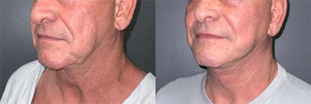 Real Patient Results in Newport Beach, CA. Preformed by Semira Bayait, MD, FACS.