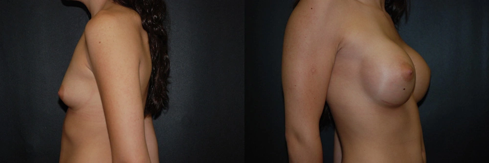 Real Patient Results in Newport Beach, CA. Preformed by Semira Bayait, MD, FACS.