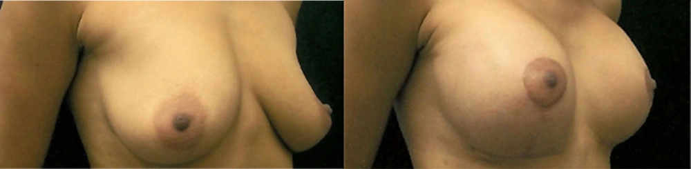 Real Patient Results in Newport Beach, CA. Preformed by Semira Bayait, MD, FACS.