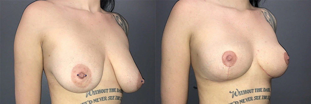 Real Patient Results in Newport Beach, CA. Preformed by Semira Bayait, MD, FACS.