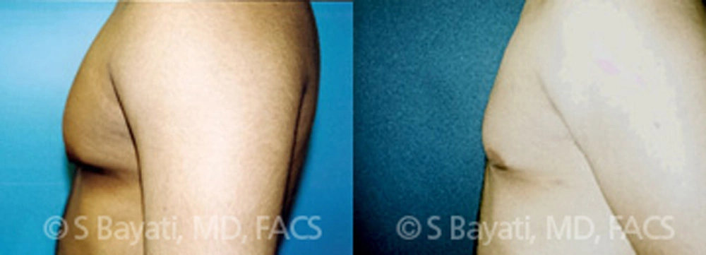 Real Patient Results in Newport Beach, CA. Preformed by Semira Bayait, MD, FACS.