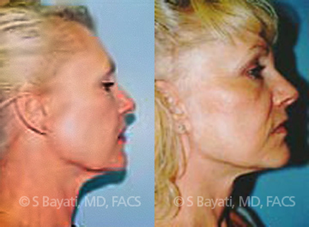 Real Patient Results in Newport Beach, CA. Preformed by Semira Bayait, MD, FACS.
