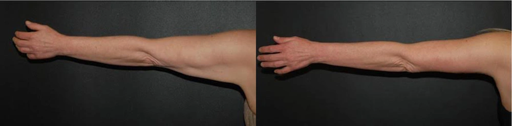 Real Patient Results in Newport Beach, CA. Preformed by Semira Bayait, MD, FACS.