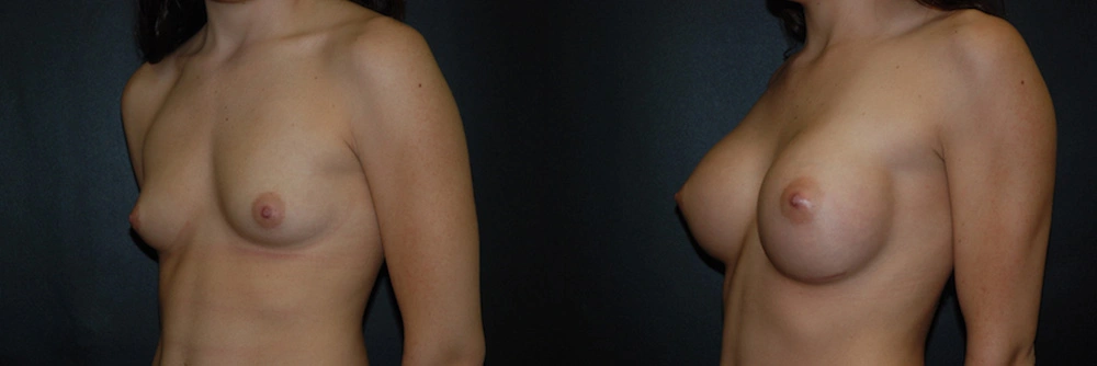 Real Patient Results in Newport Beach, CA. Preformed by Semira Bayait, MD, FACS.