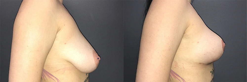 Real Patient Results in Newport Beach, CA. Preformed by Semira Bayait, MD, FACS.