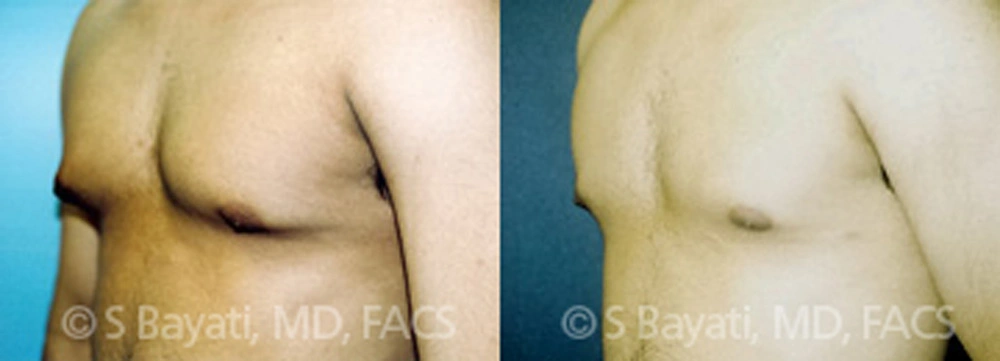 Real Patient Results in Newport Beach, CA. Preformed by Semira Bayait, MD, FACS.