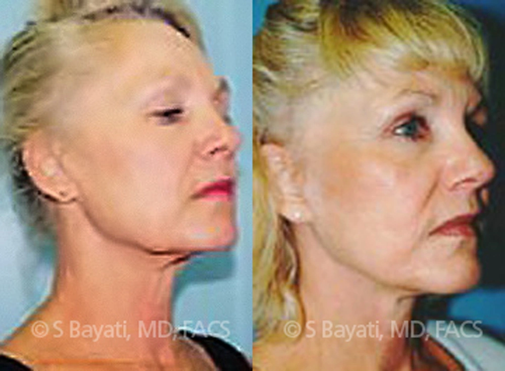 Real Patient Results in Newport Beach, CA. Preformed by Semira Bayait, MD, FACS.