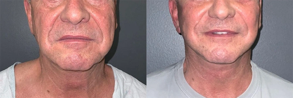 Real Patient Results in Newport Beach, CA. Preformed by Semira Bayait, MD, FACS.