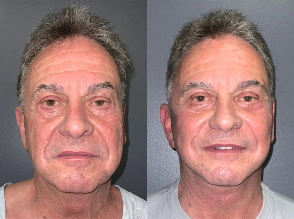 Real Patient Results in Newport Beach, CA. Preformed by Semira Bayait, MD, FACS.