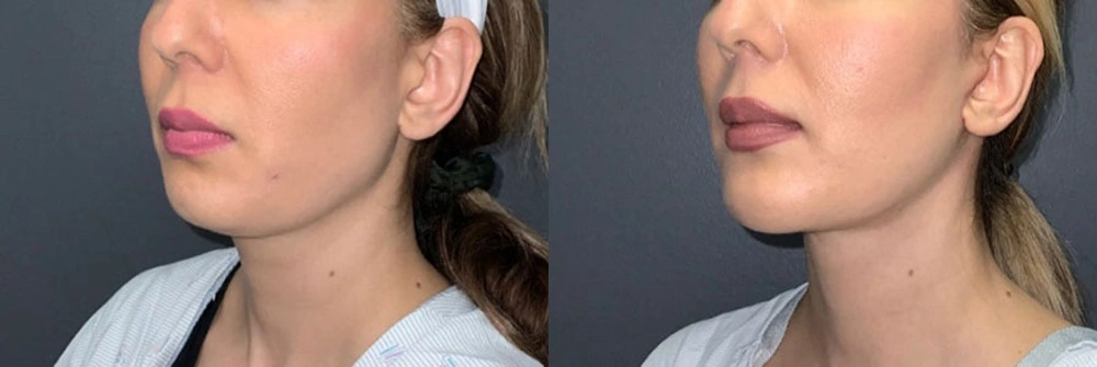 Real Patient Results in Newport Beach, CA. Preformed by Semira Bayait, MD, FACS.