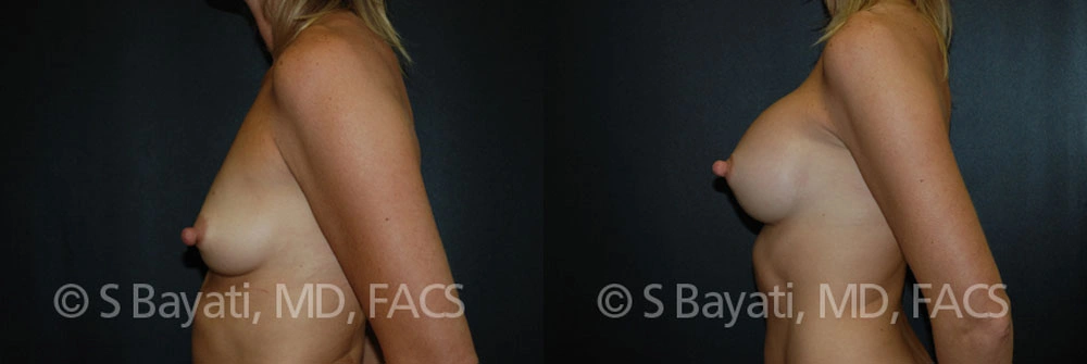 Real Patient Results in Newport Beach, CA. Preformed by Semira Bayait, MD, FACS.