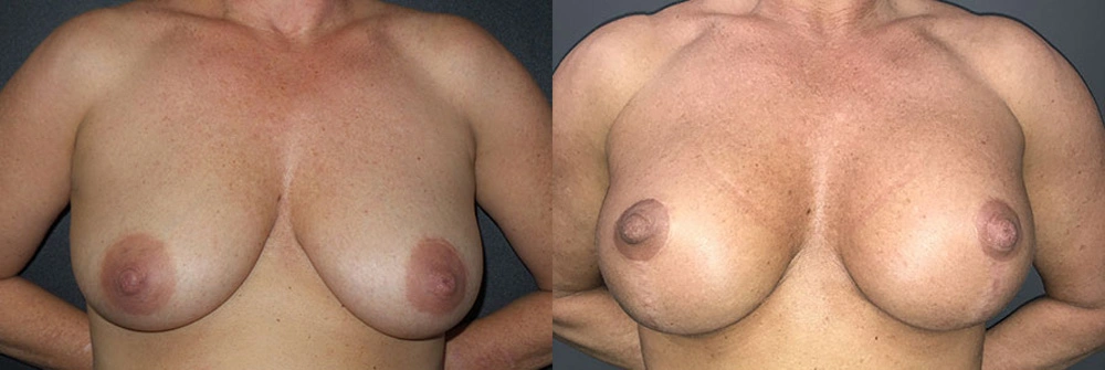 Real Patient Results in Newport Beach, CA. Preformed by Semira Bayait, MD, FACS.