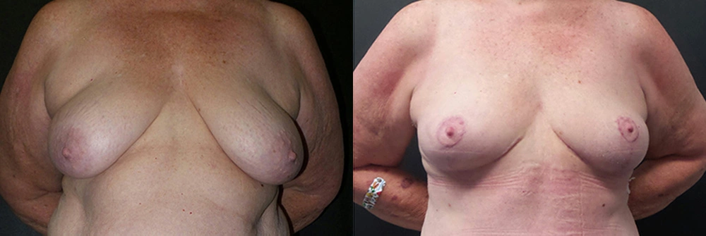 Real Patient Results in Newport Beach, CA. Preformed by Semira Bayait, MD, FACS.