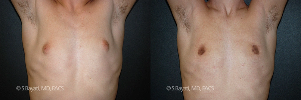 Real Patient Results in Newport Beach, CA. Preformed by Semira Bayait, MD, FACS.
