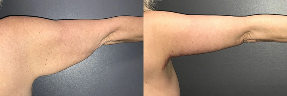 Real Patient Results in Newport Beach, CA. Preformed by Semira Bayait, MD, FACS.