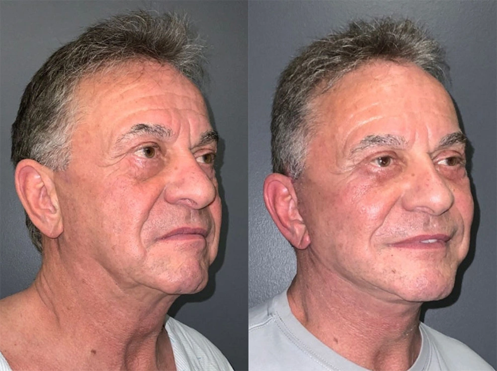 Real Patient Results in Newport Beach, CA. Preformed by Semira Bayait, MD, FACS.
