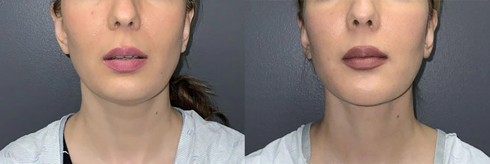 Real Patient Results in Newport Beach, CA. Preformed by Semira Bayait, MD, FACS.