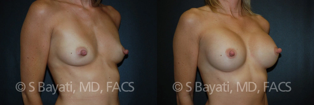 Real Patient Results in Newport Beach, CA. Preformed by Semira Bayait, MD, FACS.