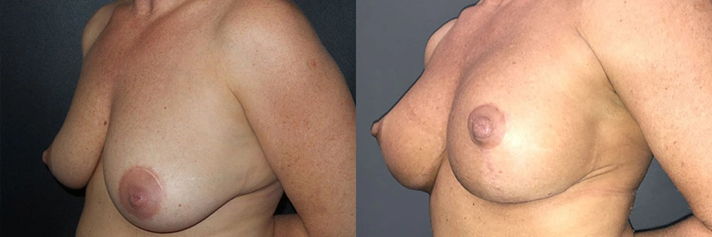 Real Patient Results in Newport Beach, CA. Preformed by Semira Bayait, MD, FACS.