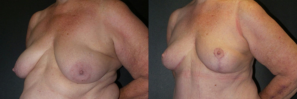 Real Patient Results in Newport Beach, CA. Preformed by Semira Bayait, MD, FACS.