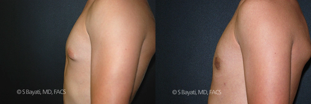 Real Patient Results in Newport Beach, CA. Preformed by Semira Bayait, MD, FACS.