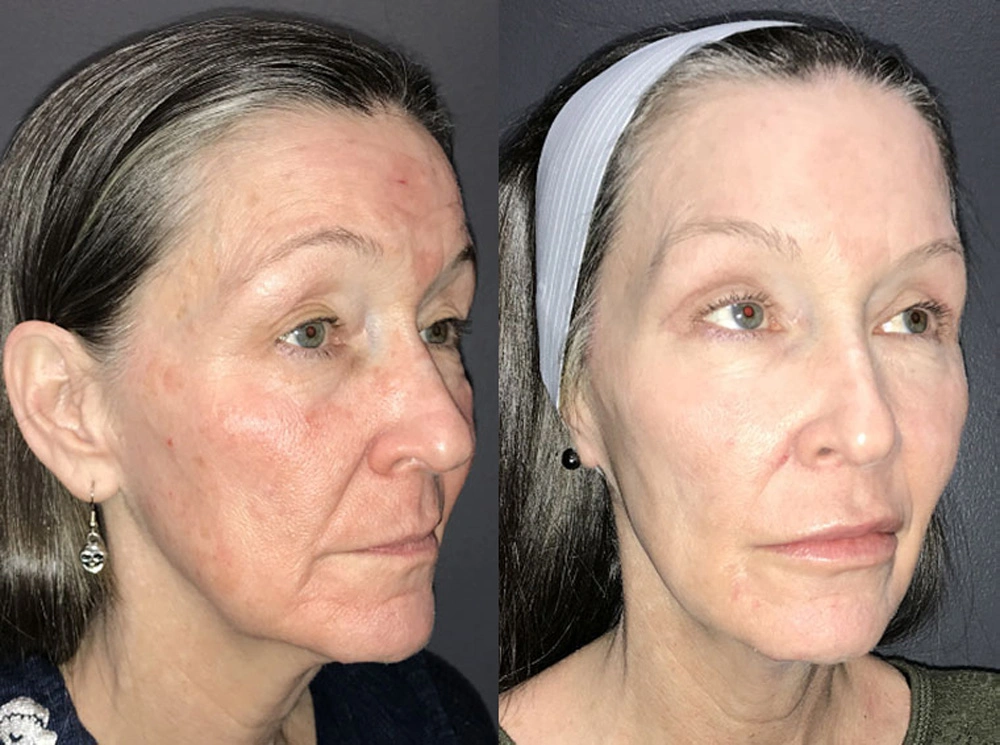 Real Patient Results in Newport Beach, CA. Preformed by Semira Bayait, MD, FACS.