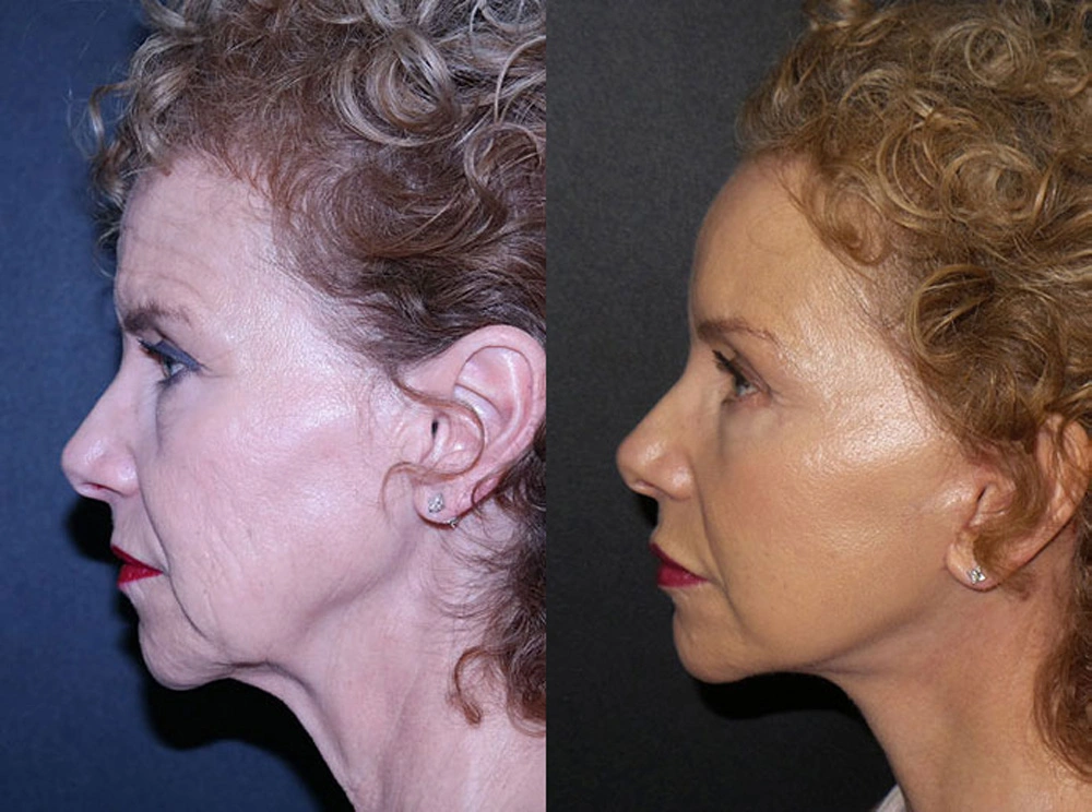 Real Patient Results in Newport Beach, CA. Preformed by Semira Bayait, MD, FACS.