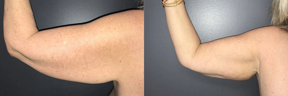Real Patient Results in Newport Beach, CA. Preformed by Semira Bayait, MD, FACS.
