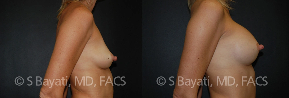 Real Patient Results in Newport Beach, CA. Preformed by Semira Bayait, MD, FACS.